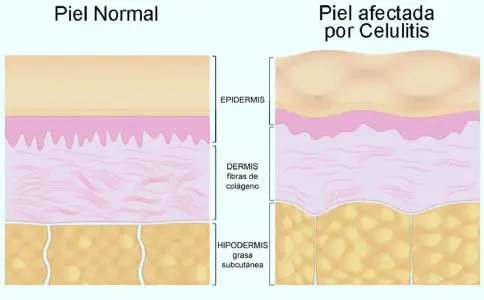 Qué es la Celulitis, definición